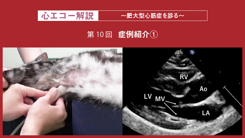 心エコー解説 ～肥大型心筋症を診る～【第10回】症例紹介①