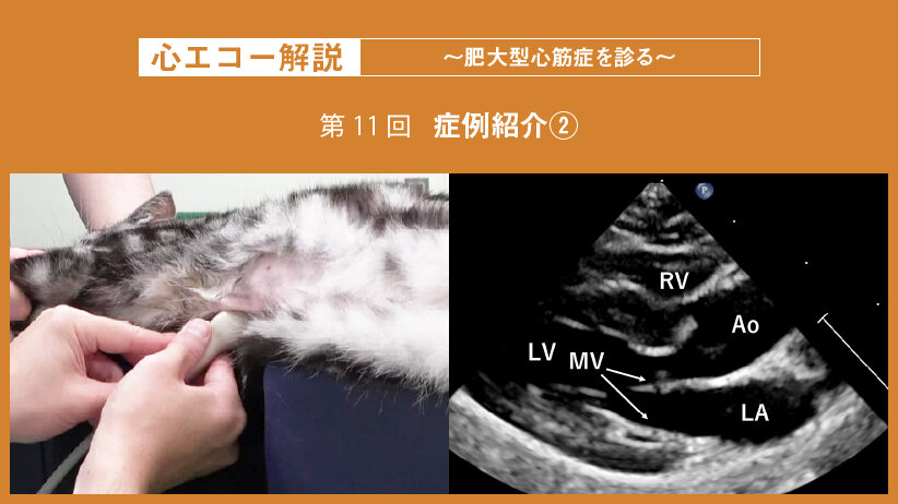 心エコー解説 ～肥大型心筋症を診る～【第11回】症例紹介②