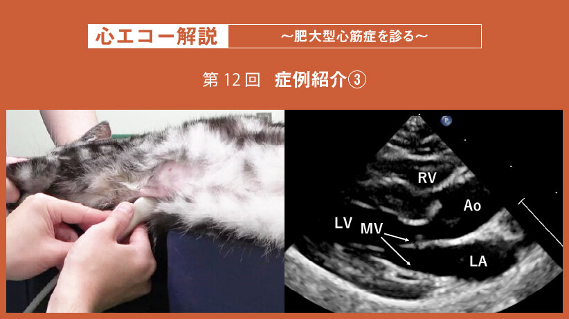 心エコー解説 ～肥大型心筋症を診る～【第12回】症例紹介③