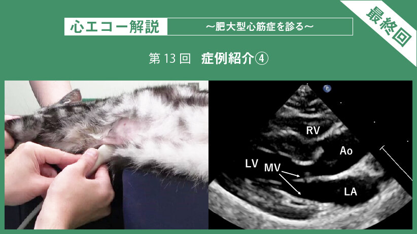 心エコー解説 ～肥大型心筋症を診る～【第13回（最終回）】症例紹介④