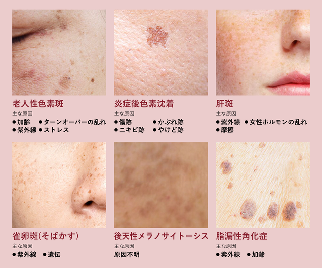 肝斑 シミ 女性 – 肝斑とシミの見分け方 , しみ・肝斑のメカニズム｜肝斑information – UDYMCY
