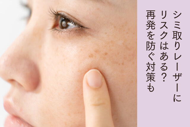 シミ取りレーザーはやめた方がいい？ 失敗しないために知って