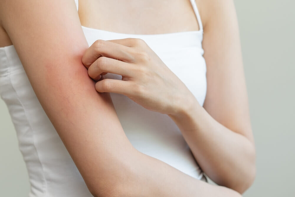 腕に赤みが出ている女性