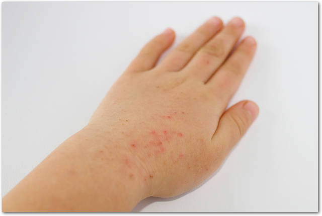 幼少期に悩まされるアトピー性皮膚炎！その原因と症状は？知っておきたい治療方法 子育て情報まとめマタイク