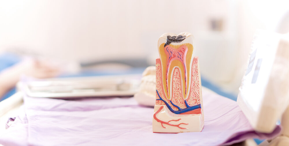 歯の神経を抜く理由は?　歯痛の原因となる歯髄炎や治療の手順を解説【歯科医師監修】