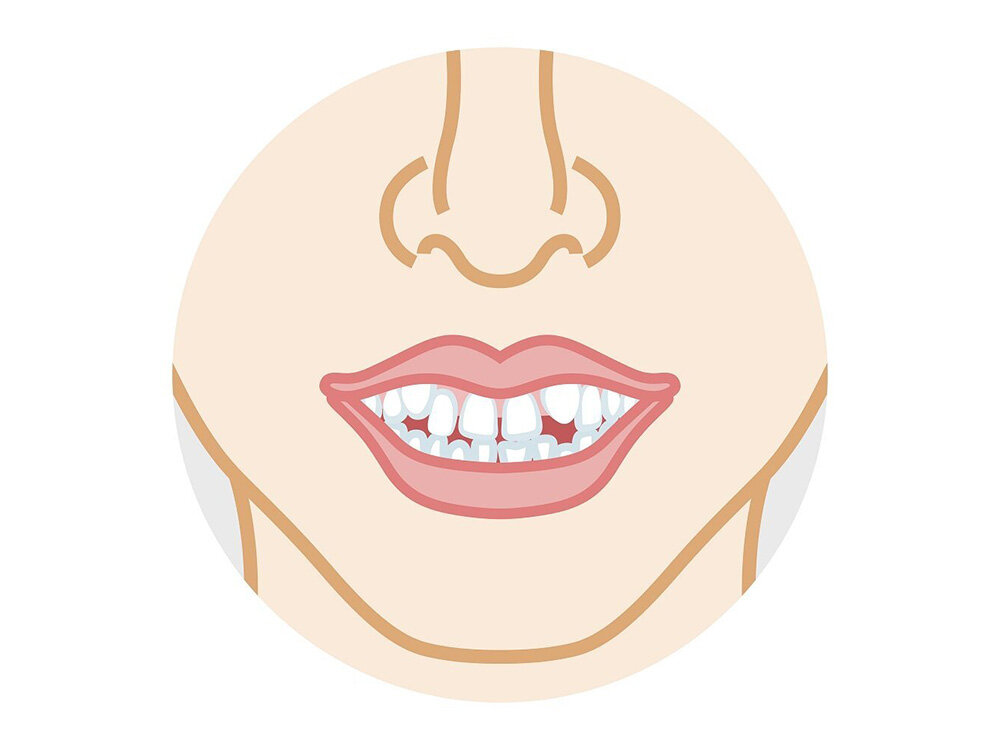 八重歯とはどんな歯?　リスクを正しく知り、適切なケアや治療を受けよう【歯科医師監修】