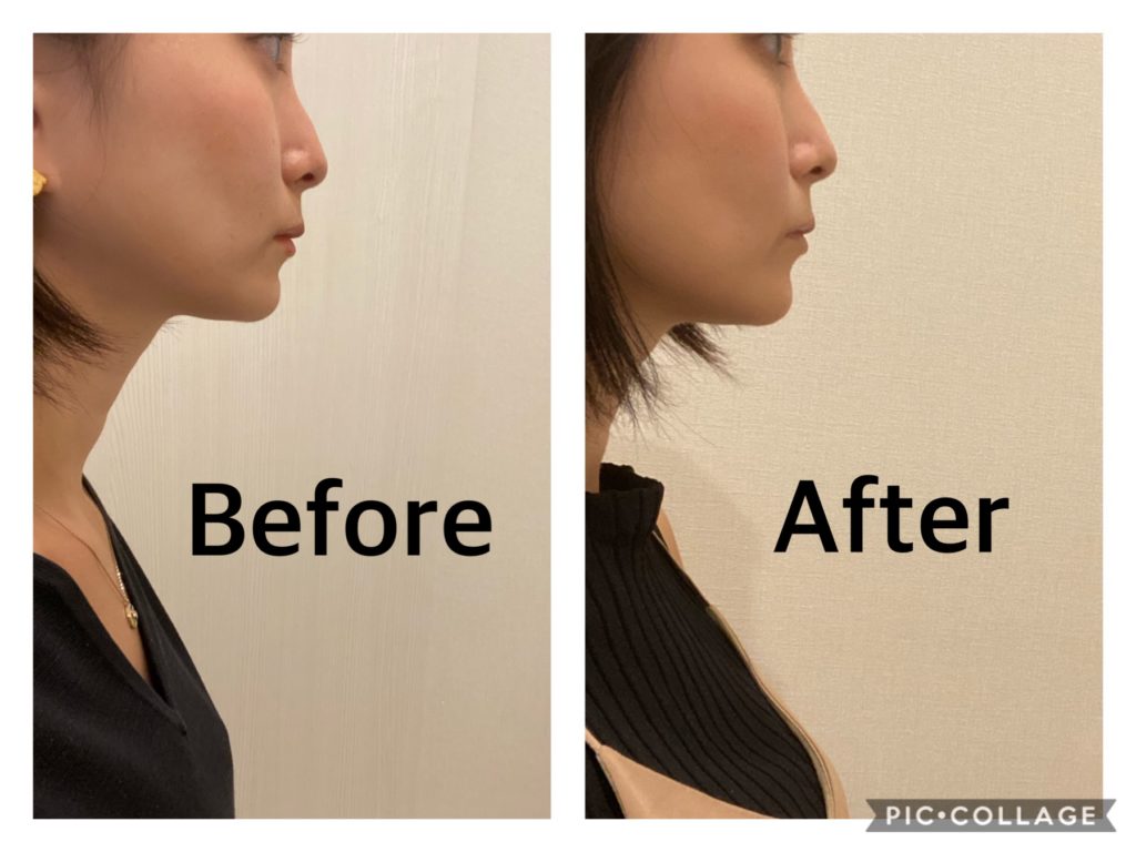 Hifu ビフォーアフターレポ ソノクイーン With Lab ビューティー With Online 講談社公式 恋も仕事もわたしらしく