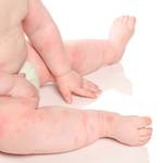 子どもの冬のあせもはなぜ起きる?あせもの原因と対処法を紹介