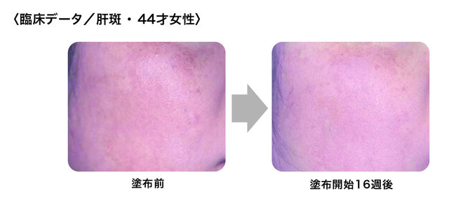 肝斑の変化