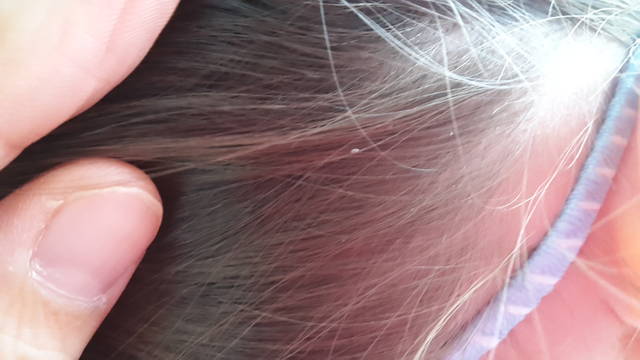 脱毛のその他の原因