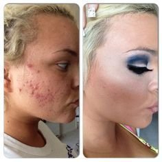 KAT VON D （キャットヴォンディー）のファンデーションカバー力