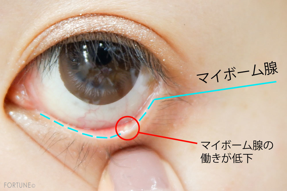 画像：マイボーム腺