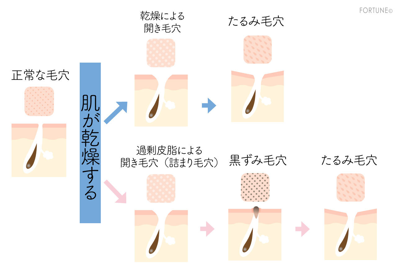毛穴トラブル