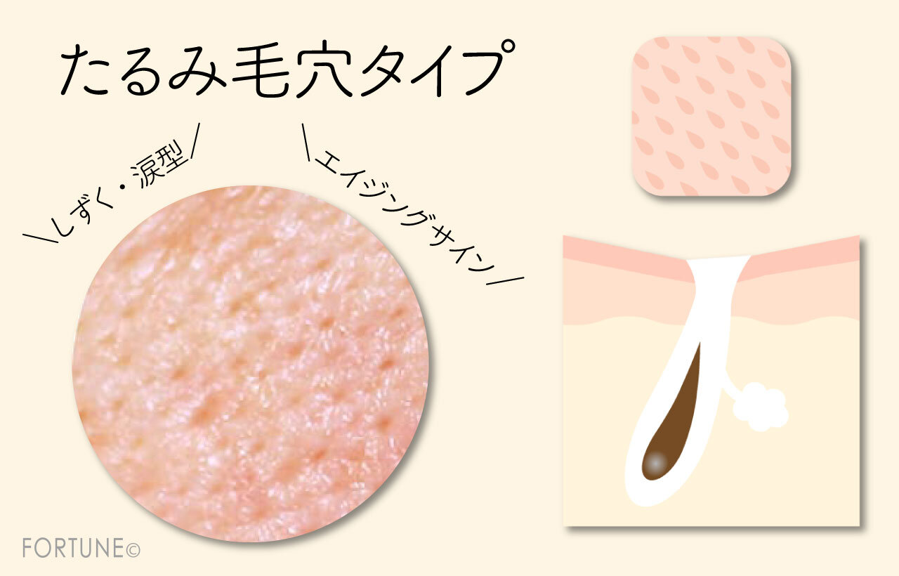 たるみ毛穴：別名「涙毛穴」