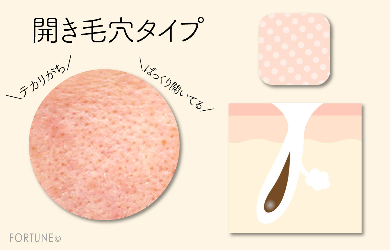 開き毛穴：別名「すり鉢毛穴・テカリ毛穴・乾燥毛穴」