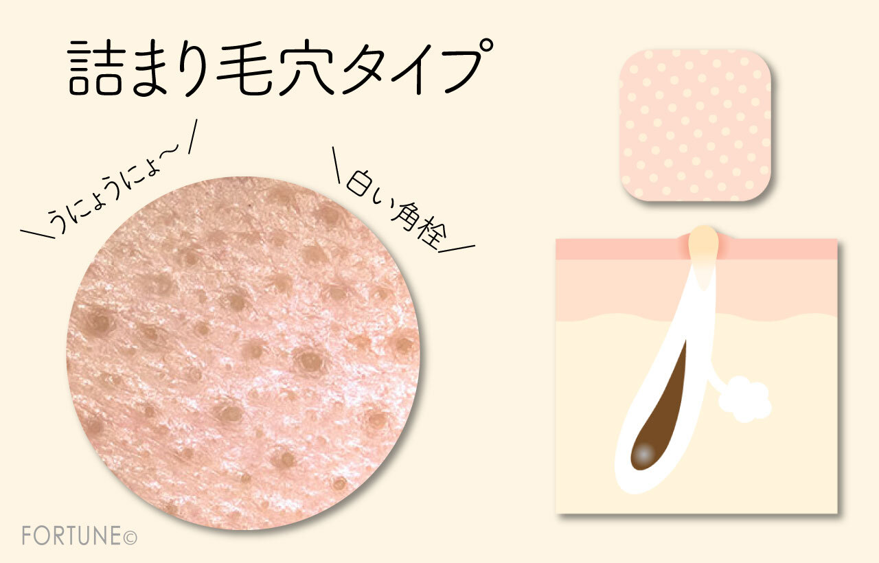 詰まり毛穴：別名「白プツ毛穴」