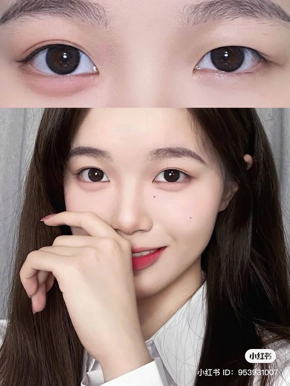 中顔面短縮　下まぶた　涙袋