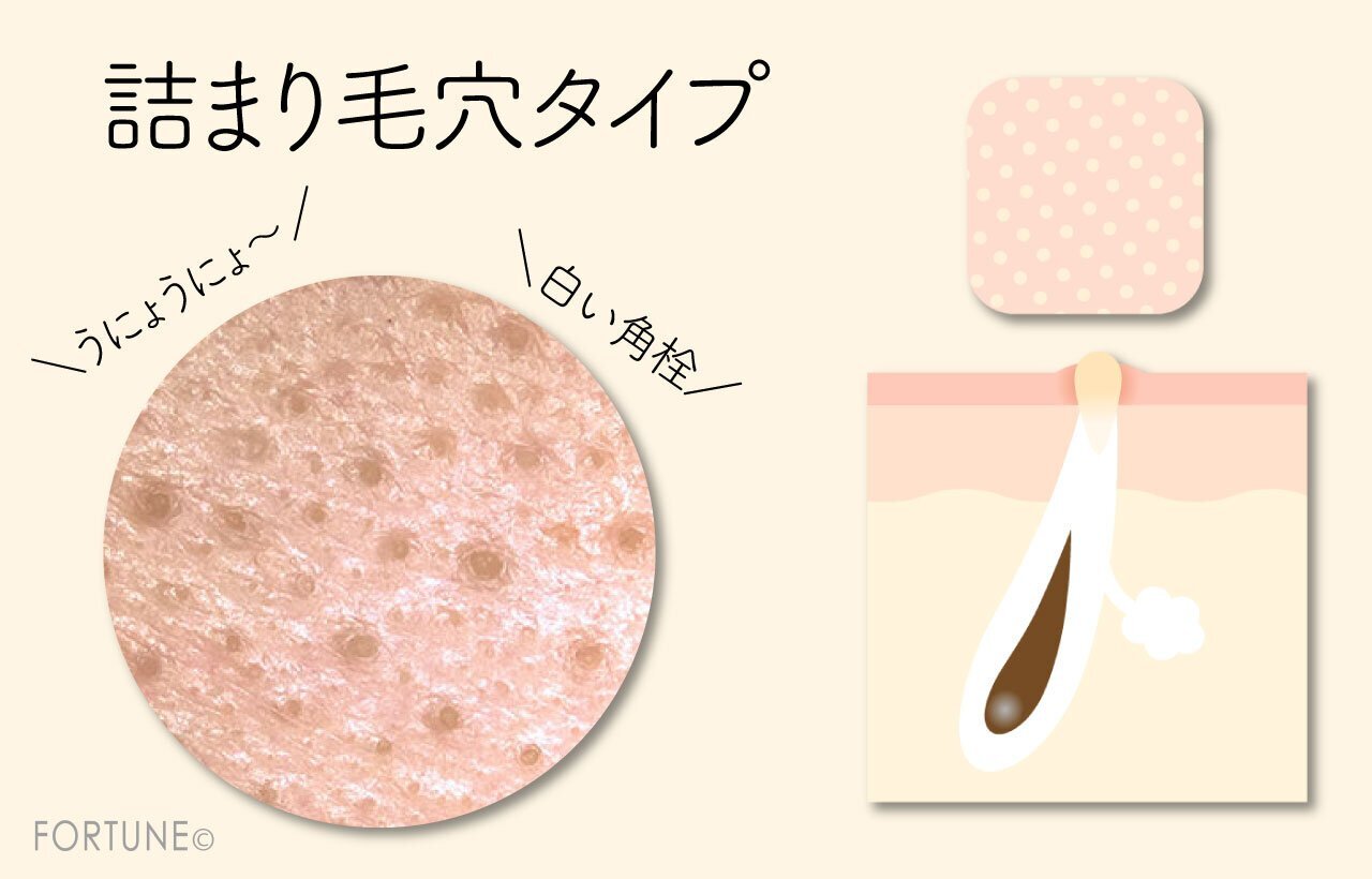 毛穴悩み　詰まり毛穴