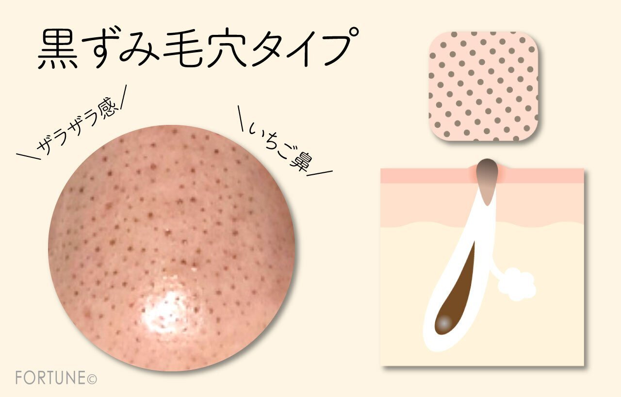 毛穴悩み　黒ずみ毛穴