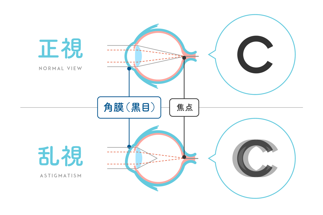 乱視用コンタクトの種類