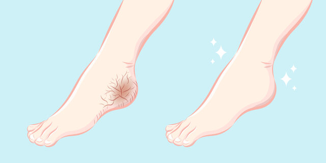 かかとの角質はどうしてひび割れる?自分でできるフットケアをしよう!