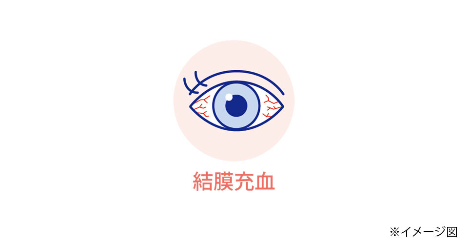 結膜充血のイメージ図