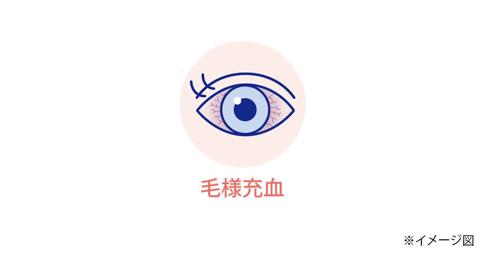 毛様充血のイメージ図