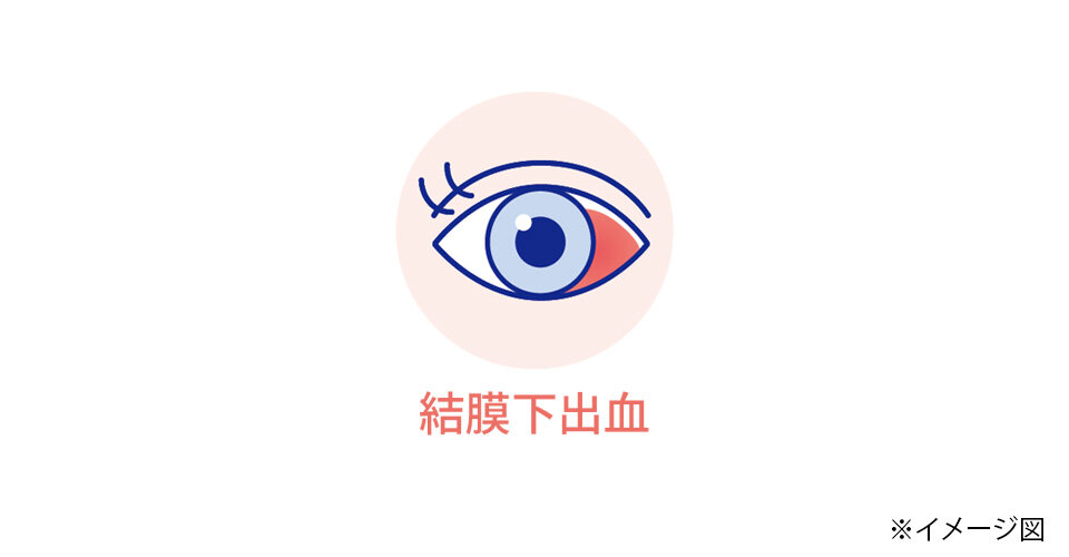 結膜下充血のイメージ図