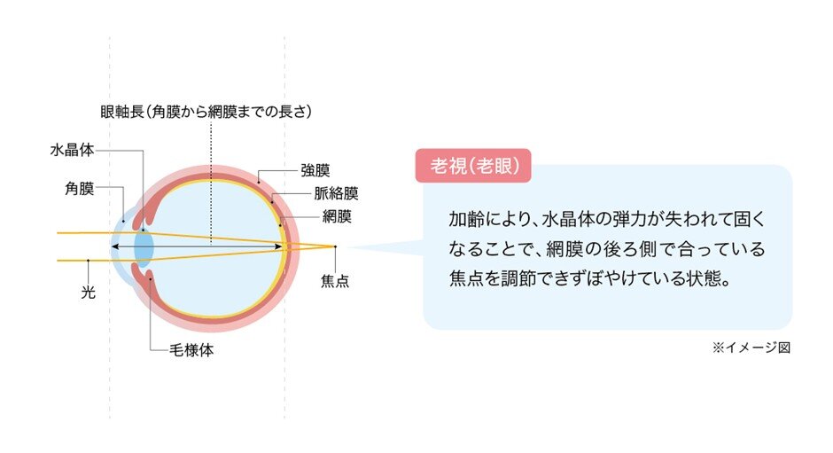 老視（老眼）の図説
